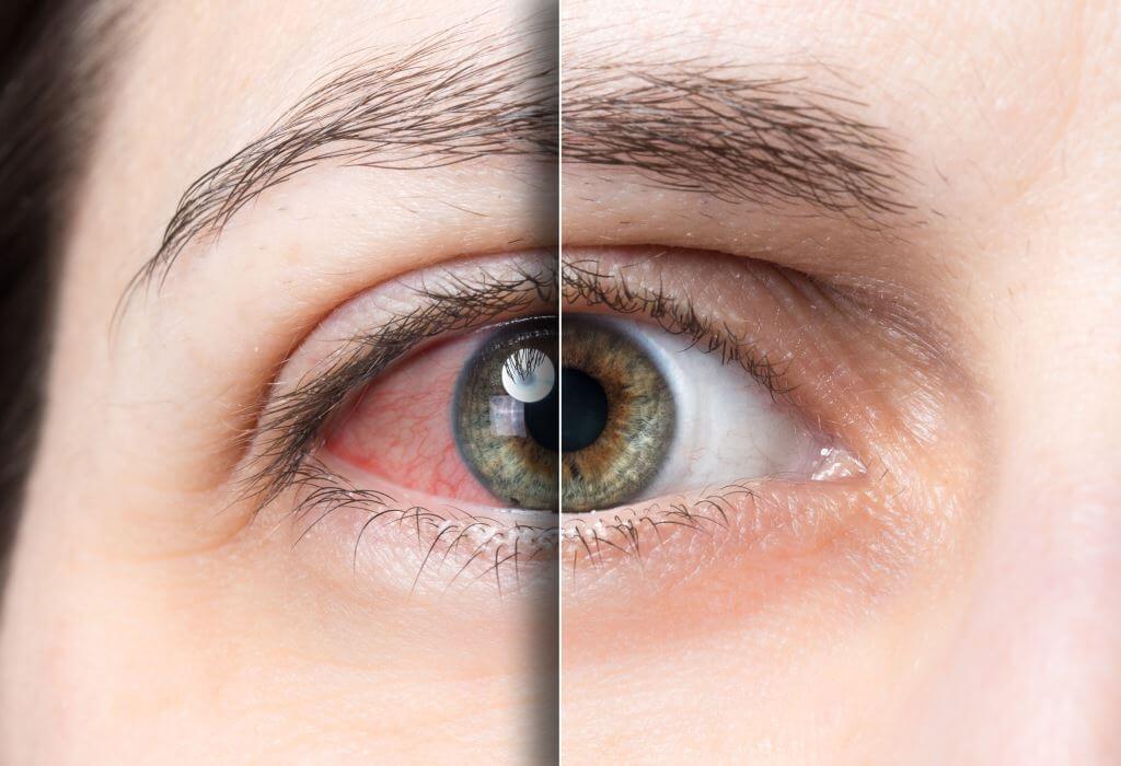 What is a dry eye disease and how to manage it?